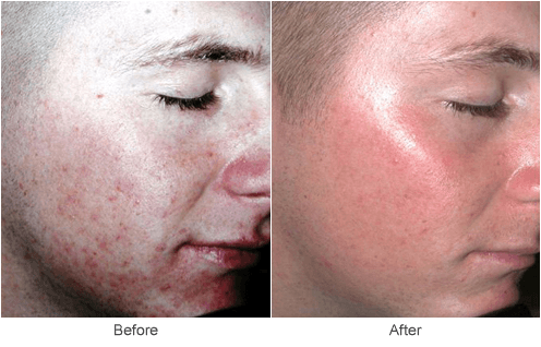 CO2 Laser Resurfacing Before and After