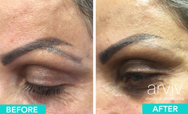 Permanent Makeup Removal | Arviv Medical Aesthetics