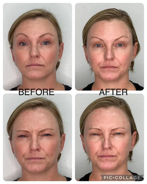 Botox before and after result at Arviv Medical Aesthetics