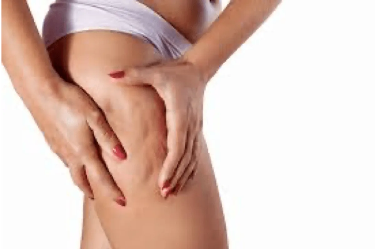 Cellulite Treatments That Actually Work
