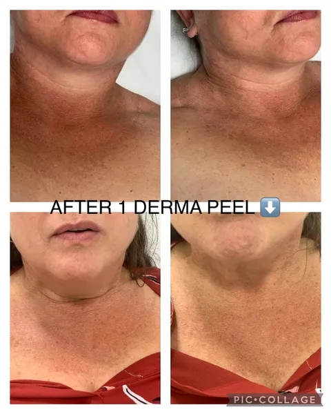 Chemical peel before and after result at Arviv Medical Aesthetics