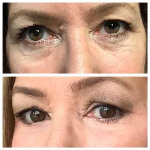 CO2 laser resurfacing before and after result 1 at Arviv Medical Aesthetics