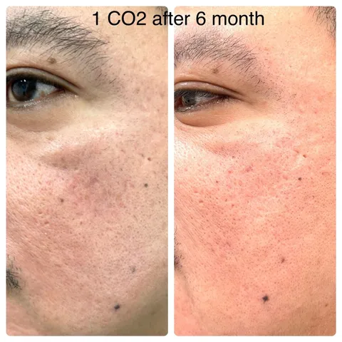 CO2 laser resurfacing before and after result 2 at Arviv Medical Aesthetics