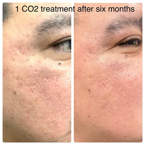 CO2 laser resurfacing before and after result 3 at Arviv Medical Aesthetics