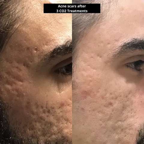 CO2 laser resurfacing before and after result 4 at Arviv Medical Aesthetics