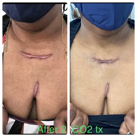CO2 laser resurfacing before and after result 5 at Arviv Medical Aesthetics