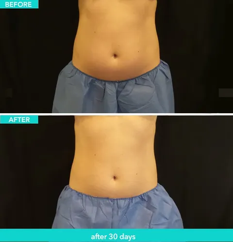 CoolSculpting before and after result 1 at Arviv Medical Aesthetics