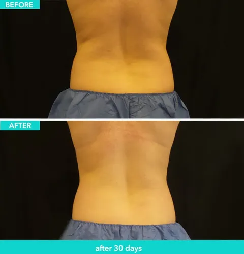 CoolSculpting before and after result 2 at Arviv Medical Aesthetics