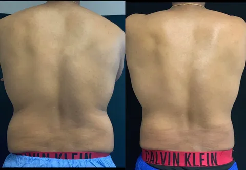 CoolSculpting before and after result 4 at Arviv Medical Aesthetics