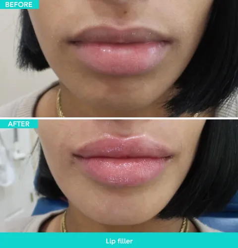 Dermal filler before and after result 1 at Arviv Medical Aesthetics