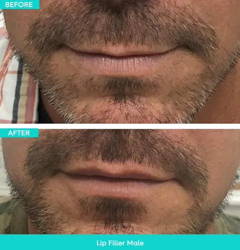 Dermal filler before and after result 2 at Arviv Medical Aesthetics
