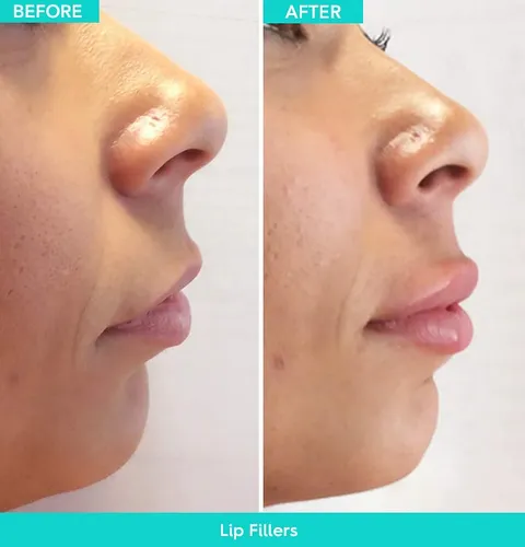Dermal filler before and after result 3 at Arviv Medical Aesthetics