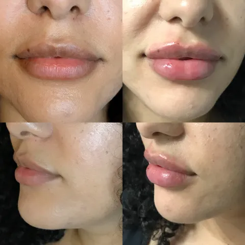 Dermal filler before and after result 4 at Arviv Medical Aesthetics