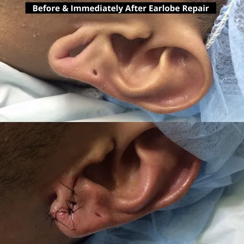 Earlobe repair before and after result at Arviv Medical Aesthetics