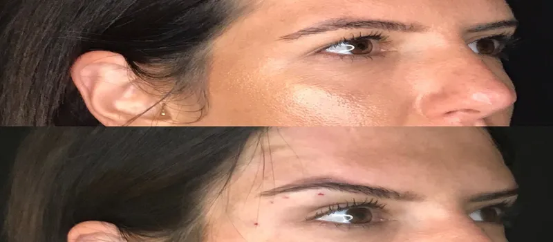 Fox Eye Lift: Your Complete Guide to the Fox Eye Lift Procedure
