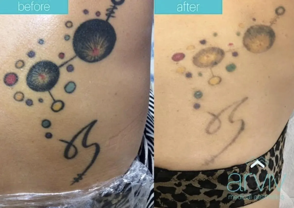 How Long Does Tattoo Removal Take and How Many Sessions?