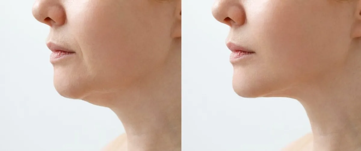 How to Tighten Neck Skin with Non-Surgical Treatments