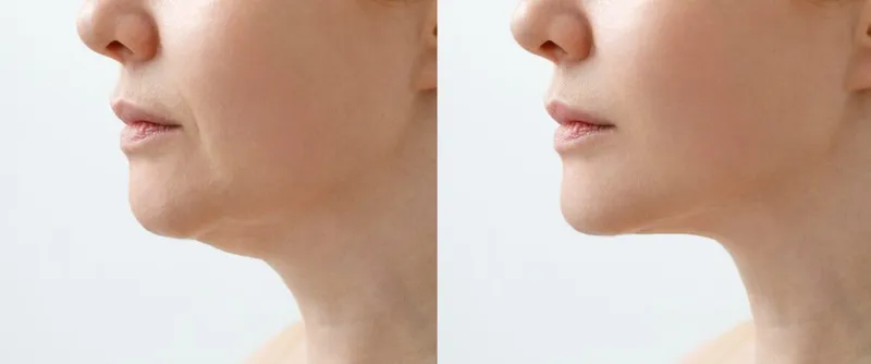 How to Tighten Neck Skin with Non-Surgical Treatments