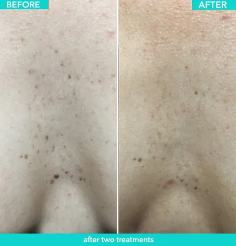 IPL & Triniti Fotofacial before and after result at Arviv Medical Aesthetics