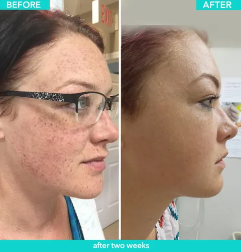 IPL & Triniti Fotofacial before and after result at Arviv Medical Aesthetics