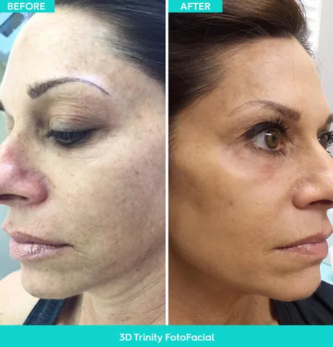 IPL & Triniti Fotofacial before and after result at Arviv Medical Aesthetics