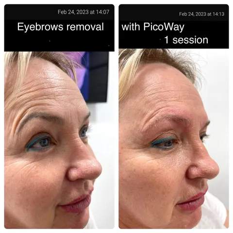 Keloid removal before and after result 1 at Arviv Medical Aesthetics