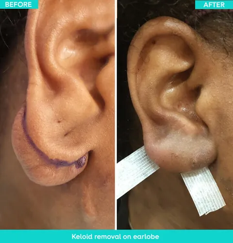 Keloid removal before and after result 2 at Arviv Medical Aesthetics