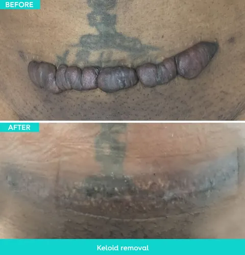 Keloid removal before and after result 3 at Arviv Medical Aesthetics