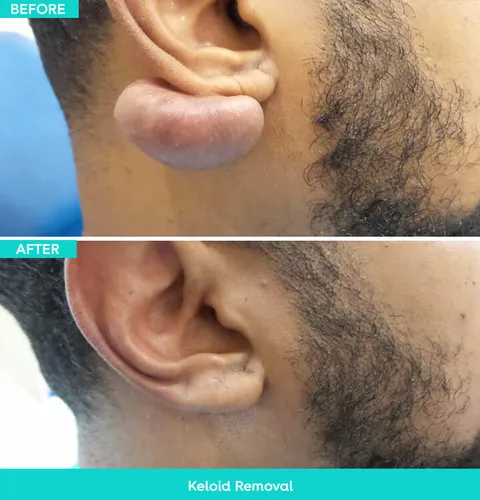 Keloid removal before and after result 4 at Arviv Medical Aesthetics