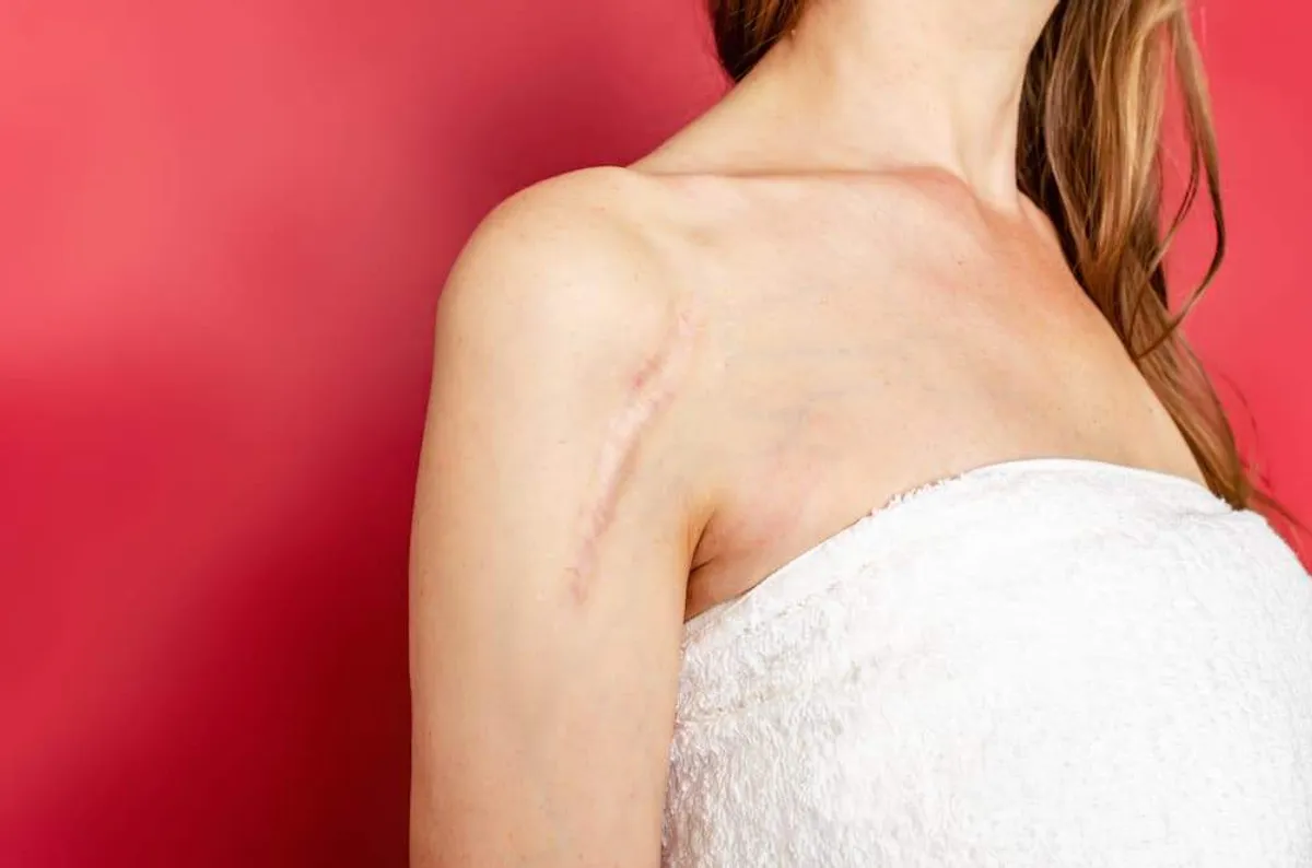 Keloids: Causes, Risk Factors, and Treatment Options