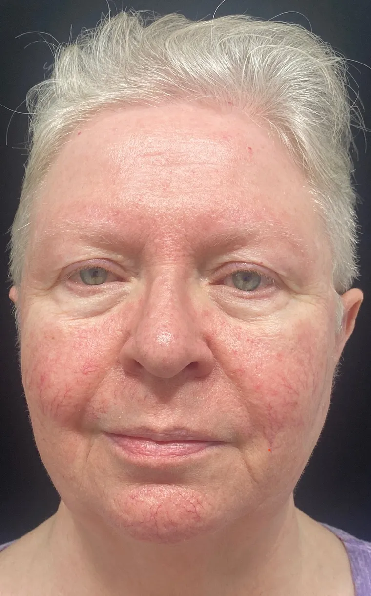 Laser vein removal before and after result 1 at Arviv Medical Aesthetics