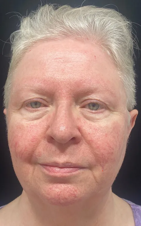Laser Vein Removal before and after result at Arviv Medical Aesthetics