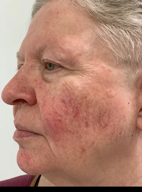 Laser Vein Removal before and after result at Arviv Medical Aesthetics