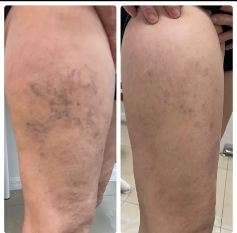 Laser Vein Removal before and after result at Arviv Medical Aesthetics