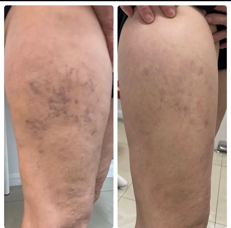 Laser vein removal before and after result 3 at Arviv Medical Aesthetics