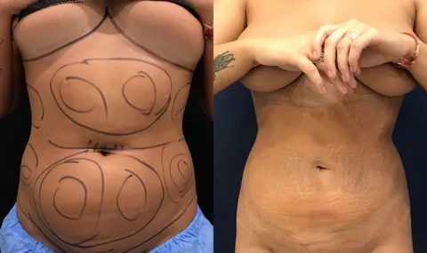 Liposuction before and after result 2 at Arviv Medical Aesthetics