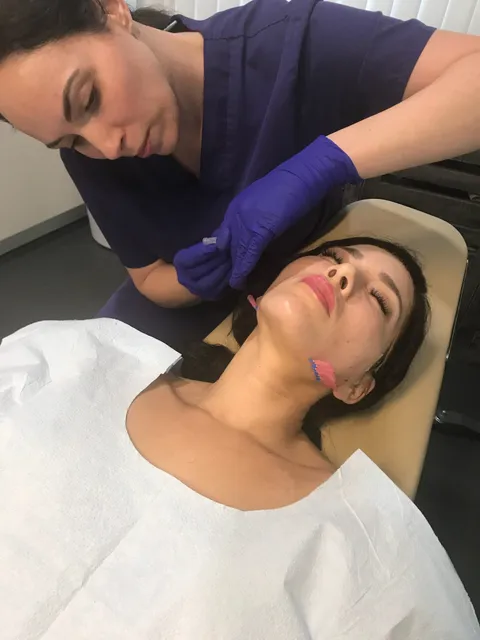 PDO thread lift before and after result 1 at Arviv Medical Aesthetics