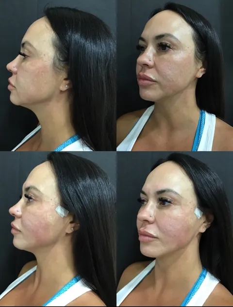 PDO thread lift before and after result 3 at Arviv Medical Aesthetics