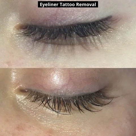 Permanent Makeup Removal before and after result at Arviv Medical Aesthetics