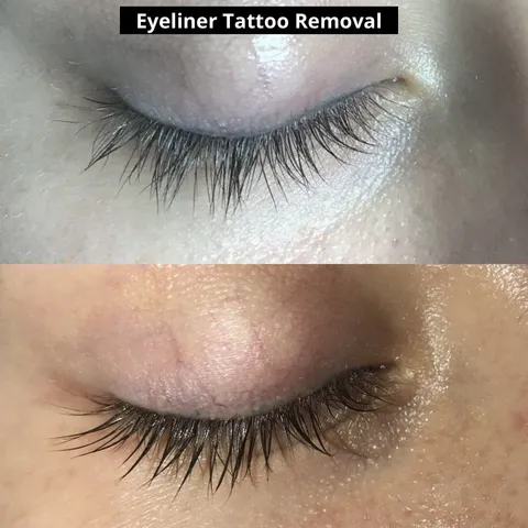 Permanent Makeup Removal before and after result at Arviv Medical Aesthetics