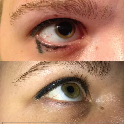 Permanent Makeup Removal before and after result at Arviv Medical Aesthetics