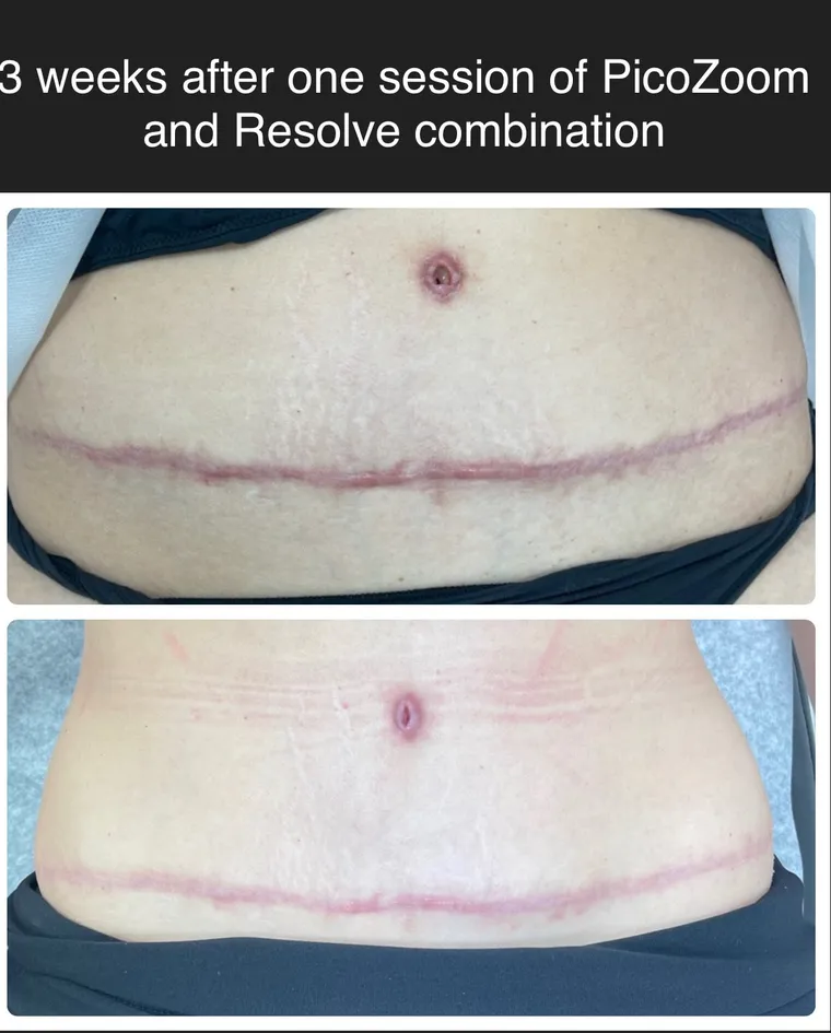 PicoWay Resolve before and after result 1 at Arviv Medical Aesthetics