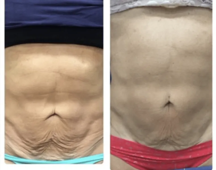 PicoWay Resolve before and after result 2 at Arviv Medical Aesthetics