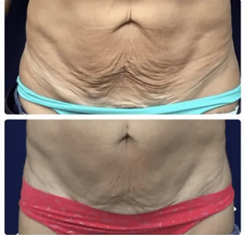 PicoWay Resolve before and after result at Arviv Medical Aesthetics