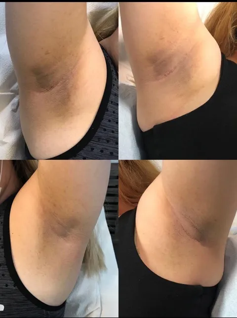 Pink Peel Skin Lightening before and after result at Arviv Medical Aesthetics