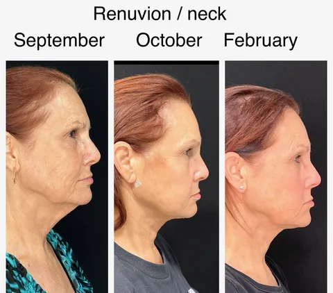 Renuvion Neck before and after result at Arviv Medical Aesthetics