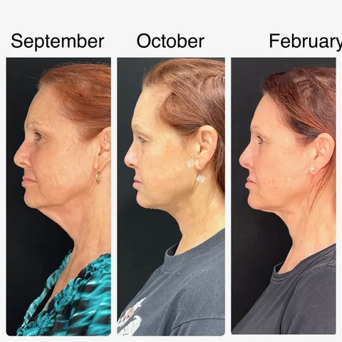 Renuvion Neck before and after result at Arviv Medical Aesthetics