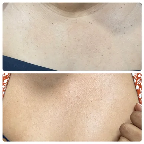 Skin tag removal before and after result 1 at Arviv Medical Aesthetics