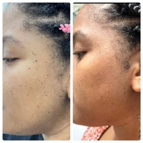 Skin tag removal before and after result 2 at Arviv Medical Aesthetics