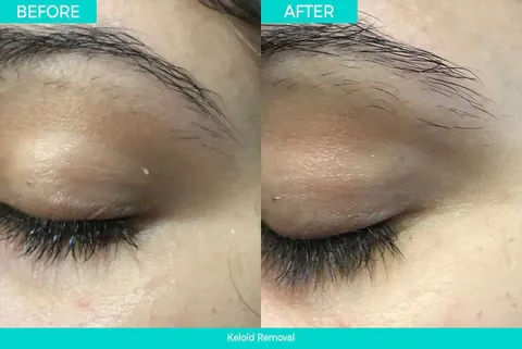 Skin tag removal before and after result 3 at Arviv Medical Aesthetics